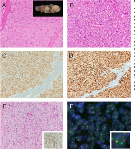 Figure 2 From High Grade Endometrial Stromal Sarcoma With Ywhae Nutm2b