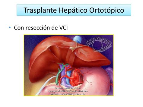 Ppt Opciones T Cnicas En El Trasplante Hep Tico Powerpoint