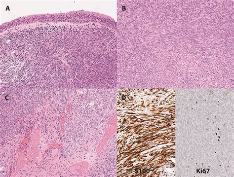 A Low Power View Of A Highly Cellular Spindle Cell Lesion