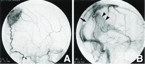 Case 2 A Preoperative Right External Carotid Angiogram Lateral View Download Scientific