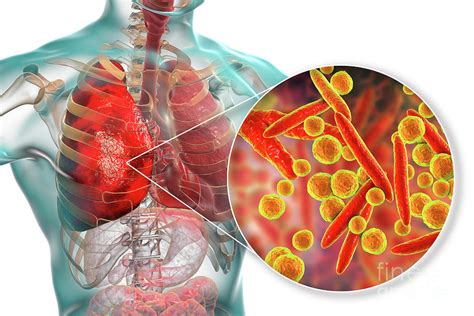 Pneumonia Caused By Moraxella Catarrhalis Photograph By Kateryna Kon