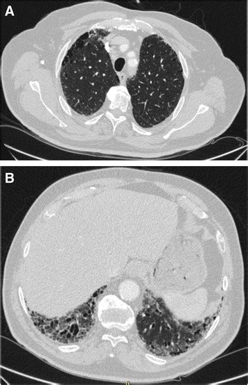 2 Nd Patient A Hrct Scan Right Above The Upper Level Of The Aortic