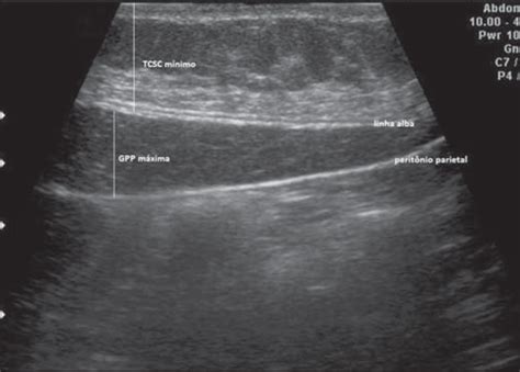 Scielo Brasil Avalia O Ultrassonogr Fica Da Gordura Visceral E