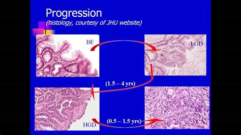 Barretts Esophagus Screening Surveillance And Therapy By Amitabh