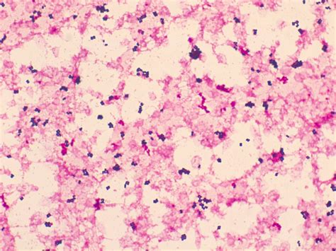 グラム染色道場（Gram stain training gym） - This image is Aerococcus urinae from ...