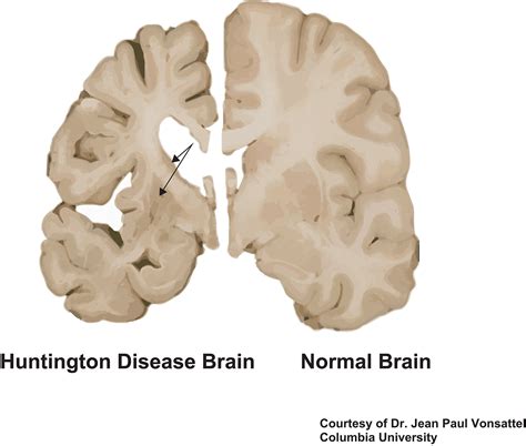 Huntingtons Disease Hd Research