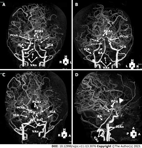 Occluded Left Internal Carotid Artery