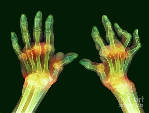 Rheumatoid Arthritis Of The Hands Photograph By Science Photo Library