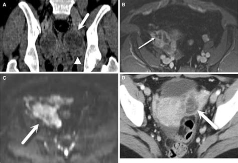 Tubo Ovarian Complex Vs Toa A A 35 Year Old Patient With Acute Download Scientific Diagram