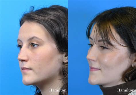 Rhinoplasty Before And After Gallery Patient 15