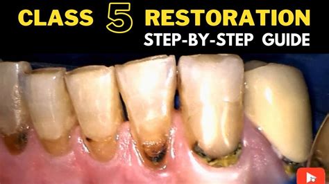 Class V Composite Restoration Procedure Guide Youtube