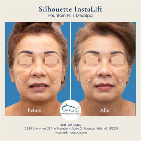 Silhouette InstaLift Non Surgical Skin Lift Fountain Hills Med Spa