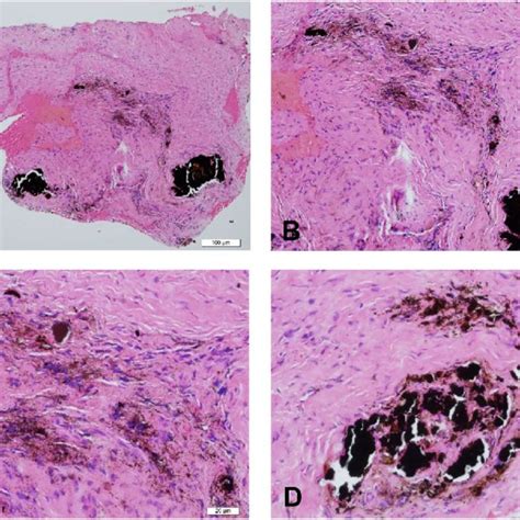 Histopathological Features Of A Periapical Scar Ps With Embedded