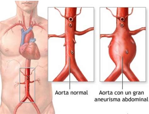 Inova Reparo Endovascular De Aneurismas De Aorta Evar