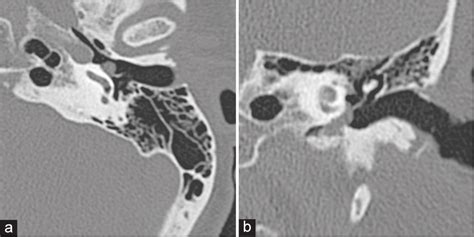 Imaging In Pulsatile Tinnitus Case Based Review Journal Of Clinical Imaging Science