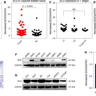 SCD Expression Was Upregulated In Cancer Tissue Compared To Nontumour