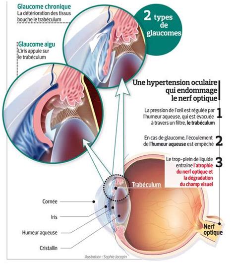 Glaucome Quest Ce Que Cest Fiches Sant Et Conseils M Dicaux
