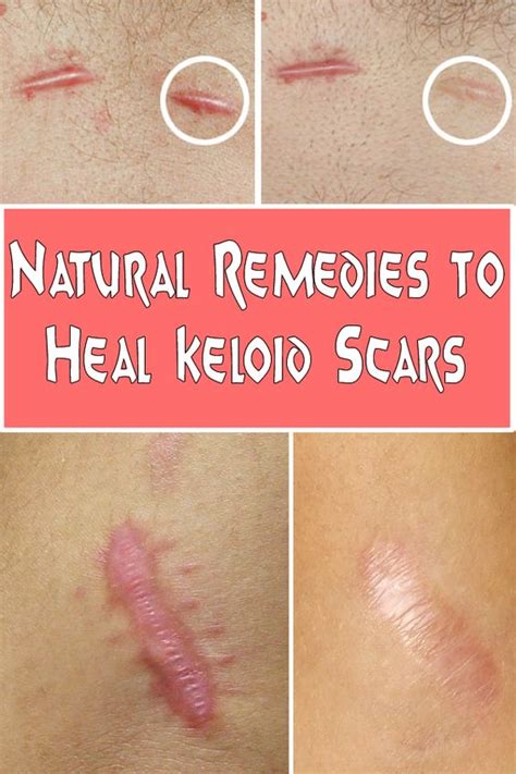 Home Remedies to Get Rid of Scar Tissue Naturally and Fast