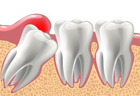 Things You Need to Know About Wisdom Tooth Infection And Complications