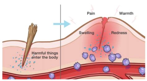 Wound Healing And Inflammation Flashcards Quizlet