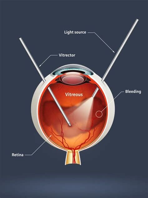 Guide To Vitrectomy Costs Timelines More NVISION