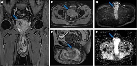 Frontiers Case Report And Literature Review Rare Male Aggressive Angiomyxoma Of The Scrotum