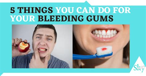 Things You Can Do For Your Bleeding Gums Sky Dental