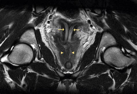 Uterus Didelphys Anatomic Variant Xiang 2018 Journal Of Medical