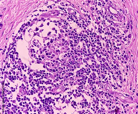 Breast Cancer Invasive Squamous Cell Carcinoma Of Areola Of Breast