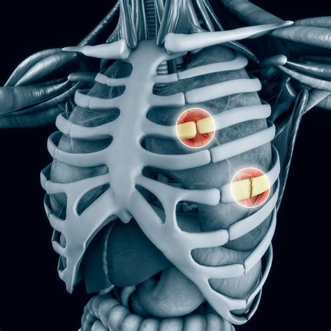 Treatment of Rib Fracture: Symptoms, Recovery Time and Surgical ...