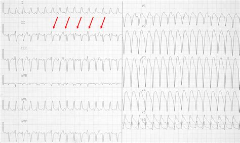 Brugada Algorithm Vt Vs Aberrant Svt Ecg Book