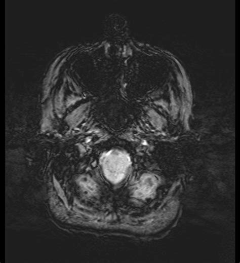 Choroid Plexus Xanthogranuloma Radiopaedia Axial Swi