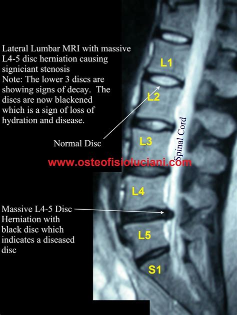 lumbar spine muscle anatomy mri