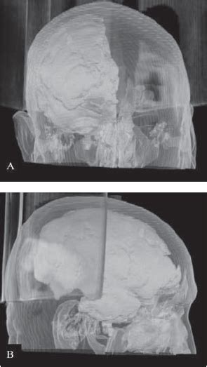 Cranial Computed Tomography 3d Reconstruction After The First Download Scientific Diagram