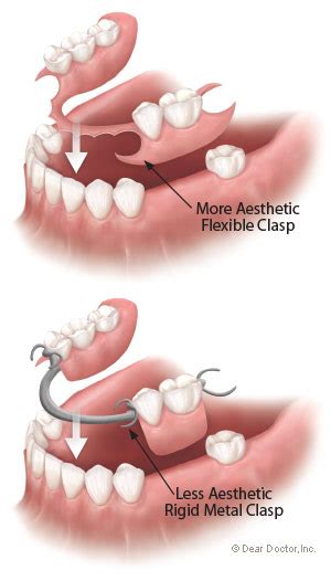 Flexible Partial Dentures - Biermann Orthodontics