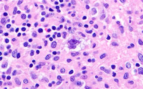 Pathology Outlines Classic Hodgkin Lymphoma Ptld