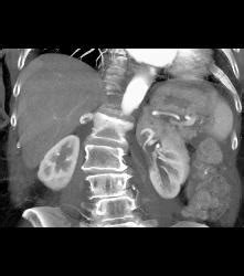 Right Adrenal Metastases From Renal Cell Carcinoma Kidney Case