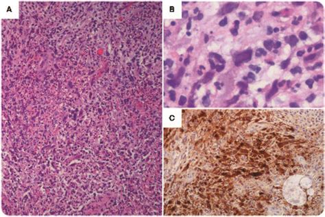 Herpes Simplex Virus Lymphadenitis