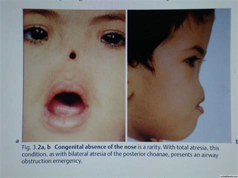 Congenital Anomalies Of Nose And Nasal Trauma Pptx د احمد محي