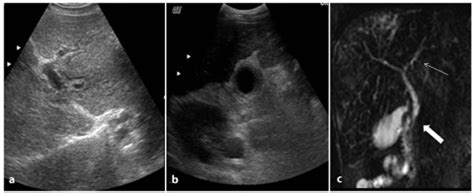 Cholangitis | Radiology Key