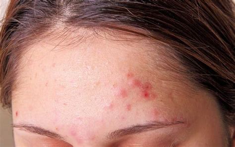 What Causes Forehead Acne Antipodium