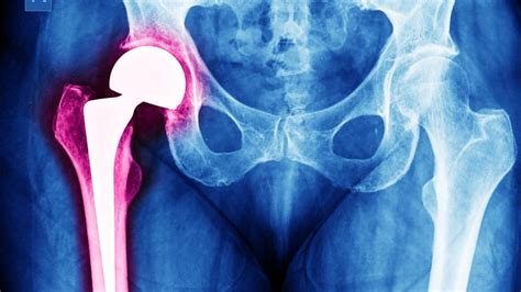 Infección de Prótesis de Cadera Causas Síntomas y Tratamiento