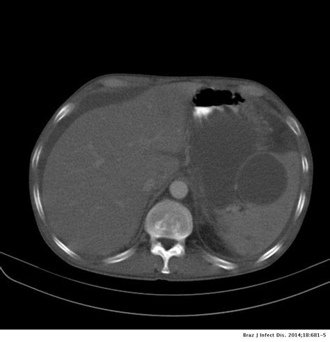 Extra Pulmonary Pneumocystis Jiroveci Infection A Case Report The Brazilian Journal Of