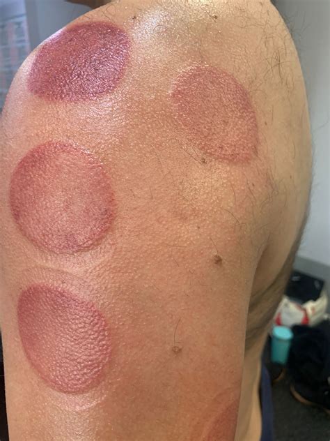 Curious About Cupping Spinal Care Clinics