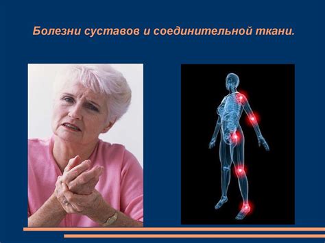 Болезни суставов и соединительной ткани - презентация онлайн