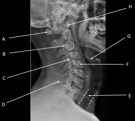 Drad Spine Diagram Labelling Radiographic Images Flashcards