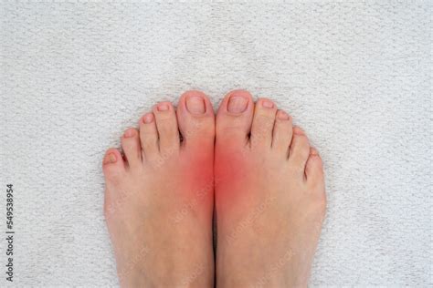 Feet disease Rheumatism and gout. Painful gout inflammation on big toe ...