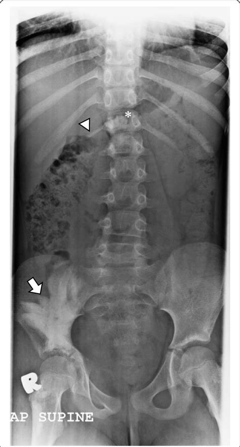 Flowing Candle Wax Appearance At The Right Ilium Big Arrow And T12