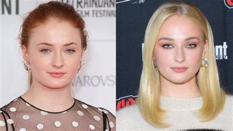 Did Sophie Turner Really Get Buccal Fat Removal Plastic Surgery Invest Records