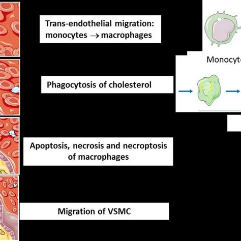 12 Atherosclerosis Stages Atherosclerosis Starts By Trans Endothelial Download Scientific